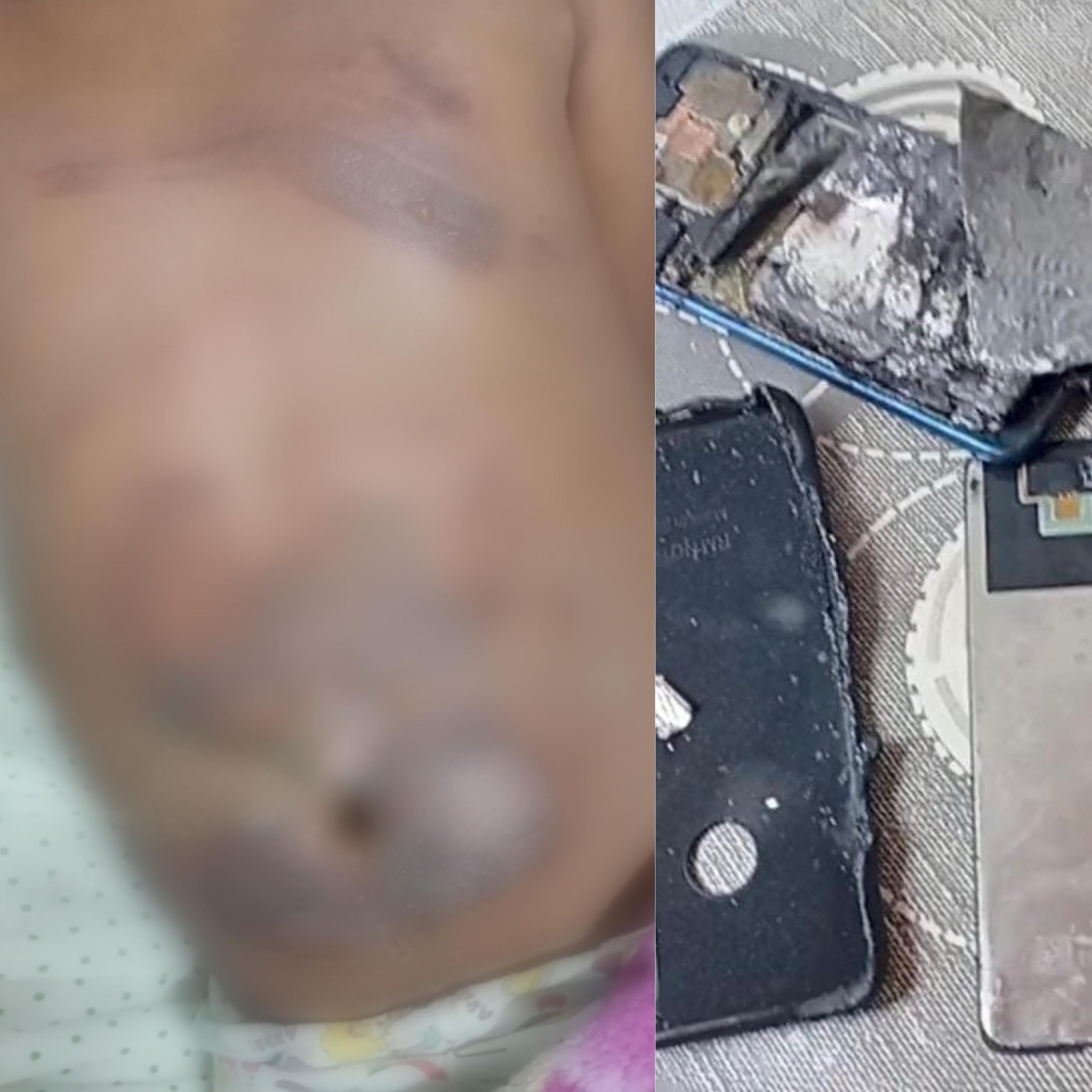 Celular pega fogo e causa queimaduras em menino de 10 anos no RN