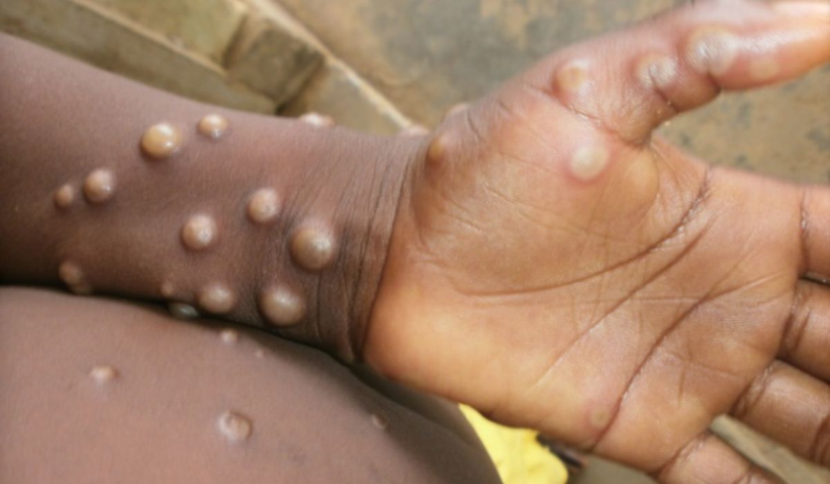 Brasil confirma 55 casos de mpox em 2026; doença segue sob vigilância