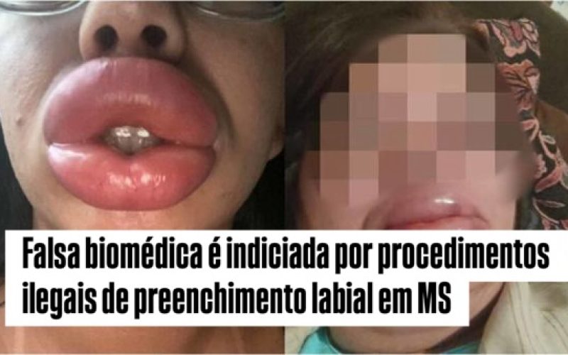 Falsa Biomédica é Indiciada por Procedimentos Estéticos Irregulares e Uso de Diploma Falso
