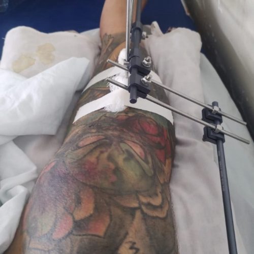 Paciente aguarda cirurgia de emergência há 11 dias no Walfredo Gurgel por falta de material hospitalar