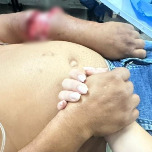 Homem é atacado pelo próprio pitbull em Areia Branca e precisa ser transferido para hospital em Mossoró