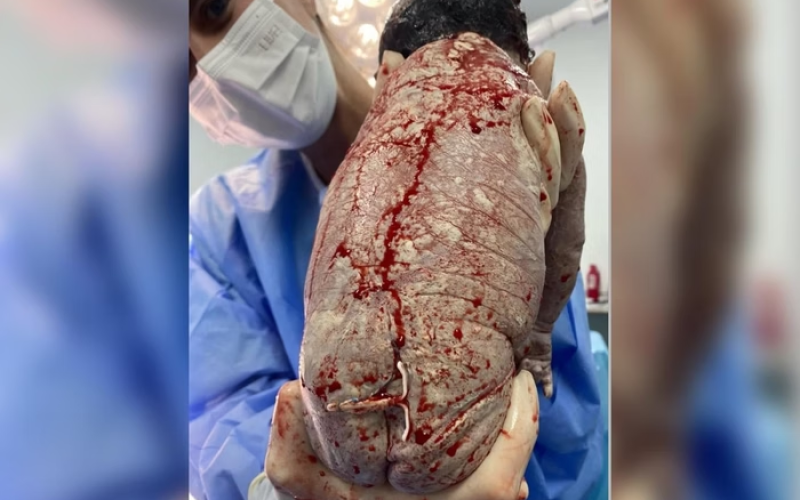 Bebê nasce com DIU colado no bumbum e imagem viraliza