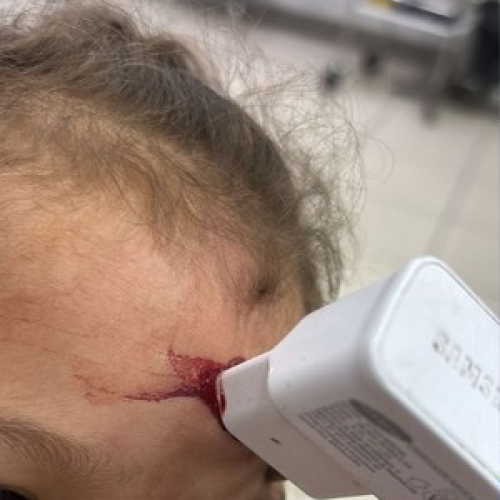 Menina de 1 ano passa por cirurgia após queda da cama com carregador cravado na testa