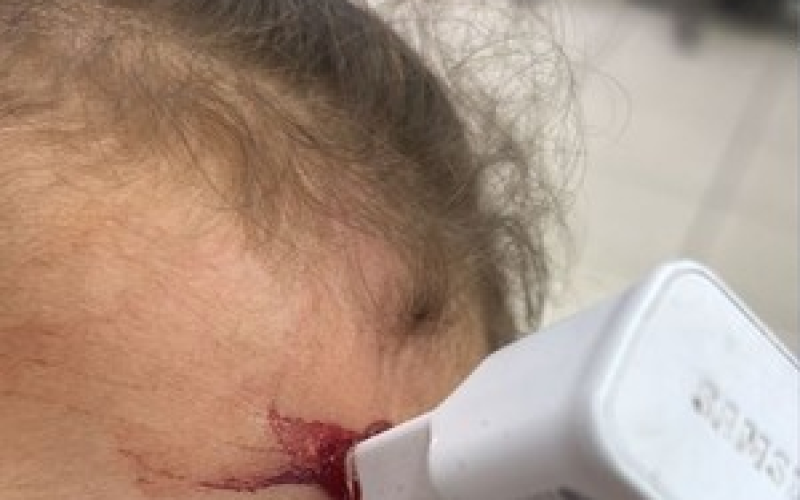 Menina de 1 ano passa por cirurgia após queda da cama com carregador cravado na testa
