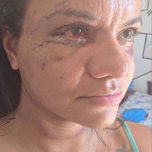 Juliana Soares mostra o rosto pela primeira vez após cirurgia de reconstrução facial
