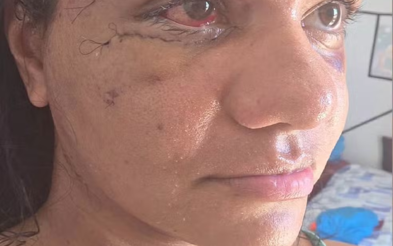 Juliana Soares mostra o rosto pela primeira vez após cirurgia de reconstrução facial