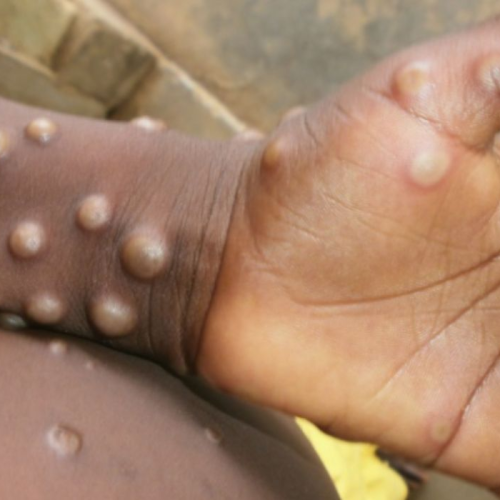 Brasil confirma 55 casos de mpox em 2026; doença segue sob vigilância