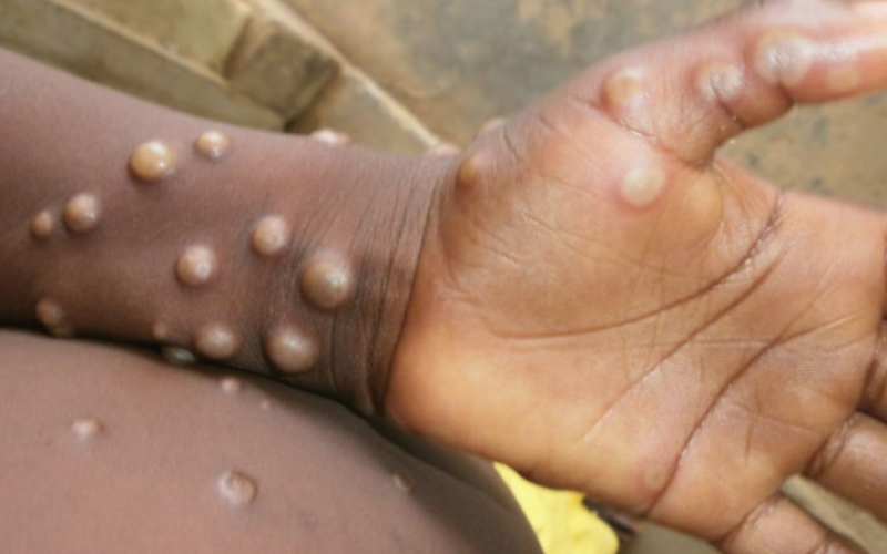 Brasil confirma 55 casos de mpox em 2026; doença segue sob vigilância
