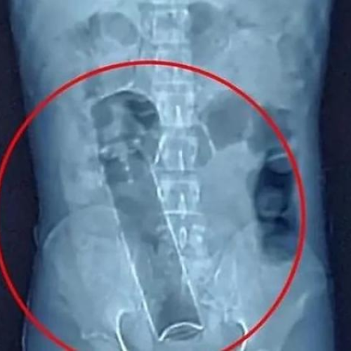 Homem dá entrada em hospital de Porto Velho com frasco de desodorante preso no reto e precisa passar por cirurgia