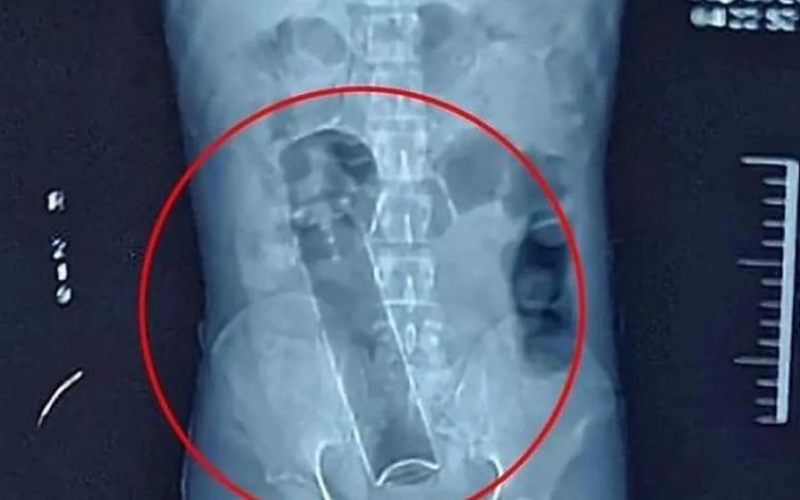 Homem dá entrada em hospital de Porto Velho com frasco de desodorante preso no reto e precisa passar por cirurgia