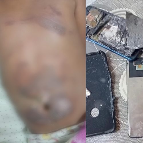Celular pega fogo e causa queimaduras em menino de 10 anos no RN