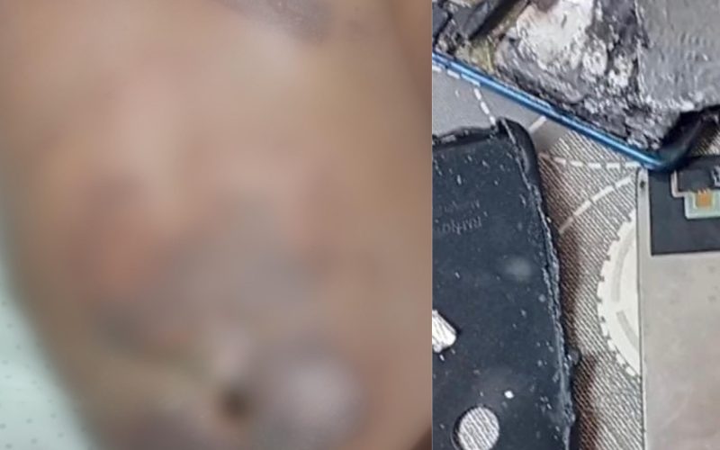Celular pega fogo e causa queimaduras em menino de 10 anos no RN